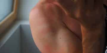 โรคผื่นภูมิแพ้ผิวหนัง